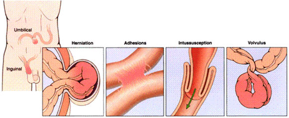 intestinal obstrüksiyon